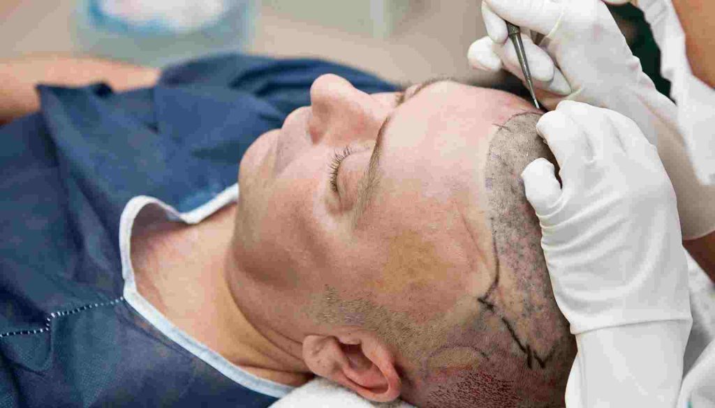 متى تثبت البصيلات بعد زراعة الشعر استعرض المقال مراحل تثبيت البصيلات، العوامل المؤثرة، وأفضل الممارسات لضمان نمو صحي ودائم للشعر المزروع.